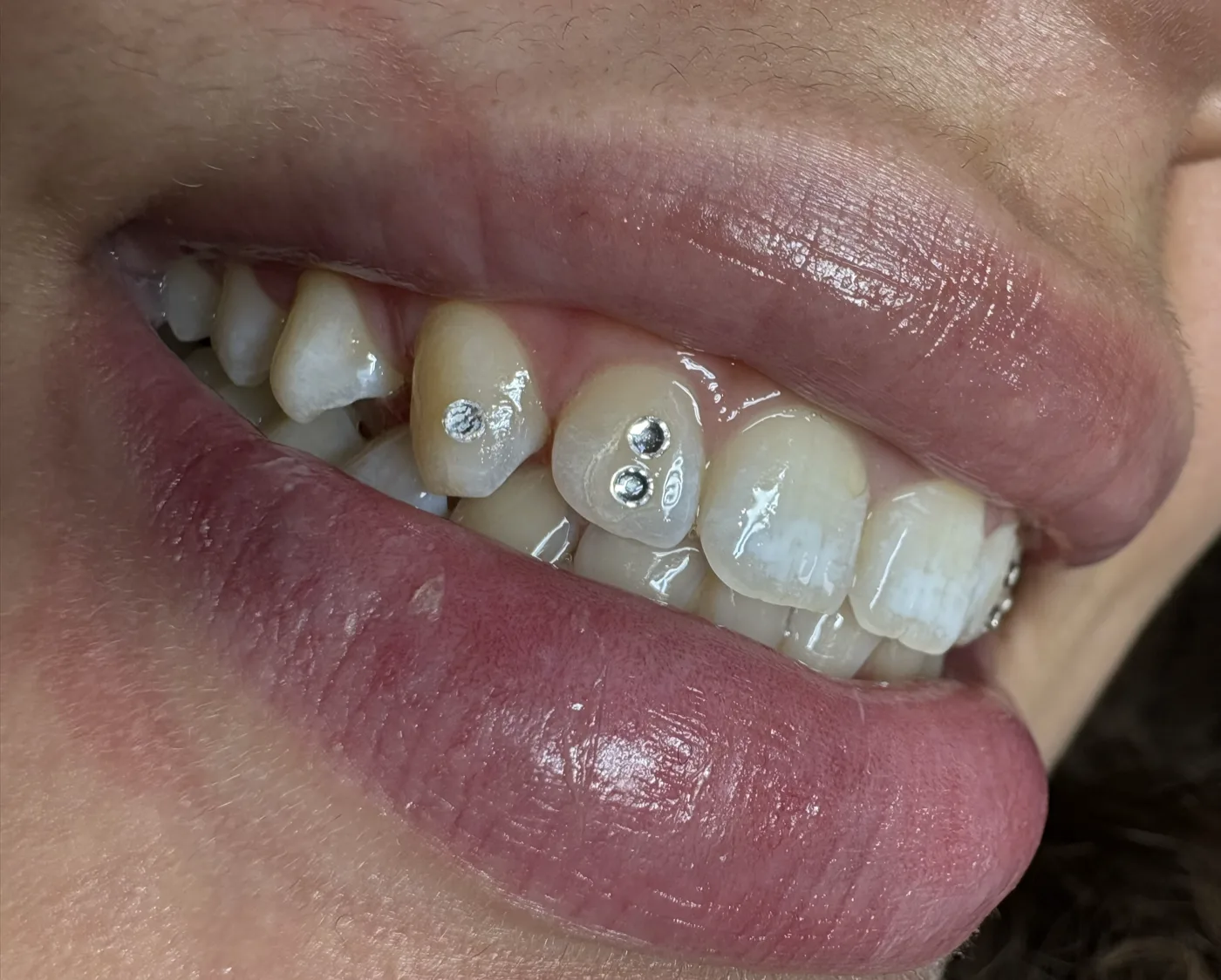 Deux strass cristal posés sur deux dents voisines