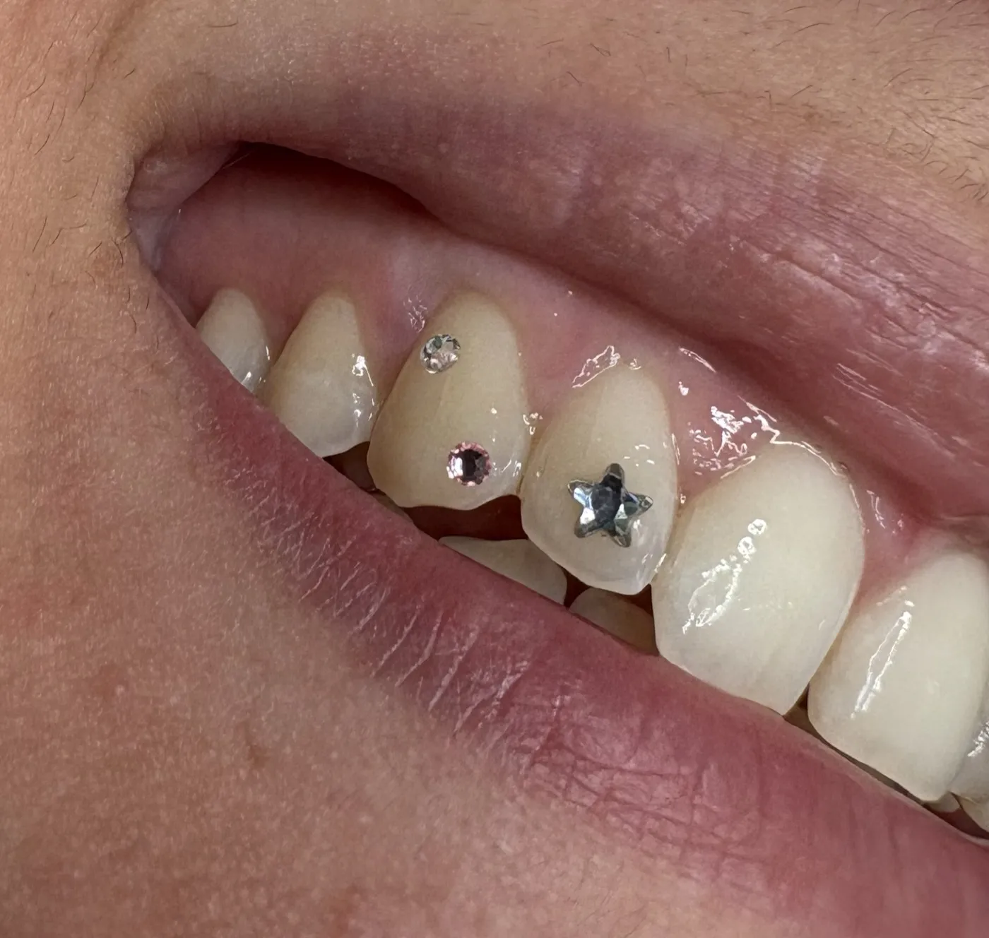 Strass étoile et strass rose posés sur les incisives