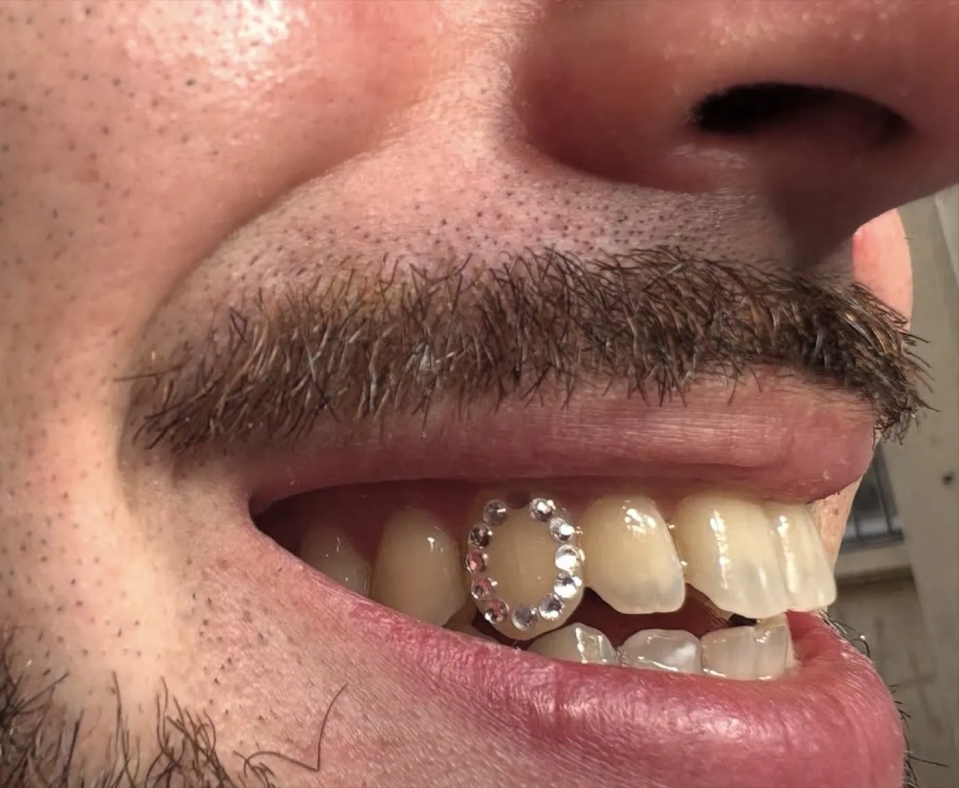 Contour complet d'une dent souligné en strass cristal