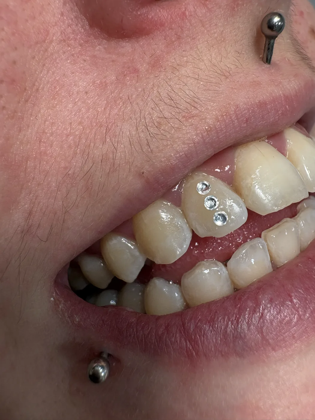 Trois strass cristal alignés sur une prémolaire